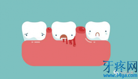 牙龈出血是什么原因及治疗方法