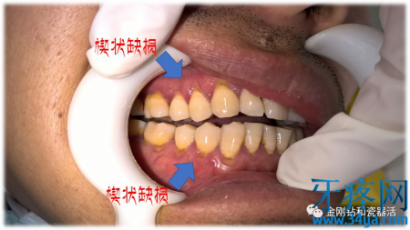 普通牙刷vs电动牙刷