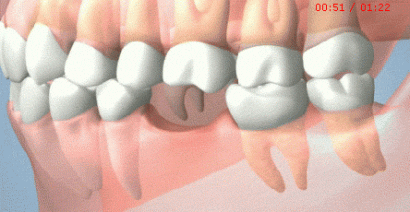 缺失的牙为什么要补起来？