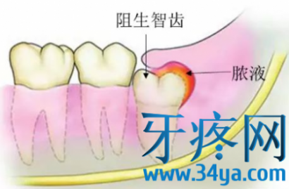 智齿冠周炎就是智齿周围的软组织发炎