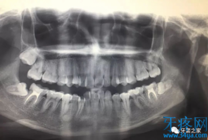 牙齿拥挤导致咬合错乱，颌关节紊乱...