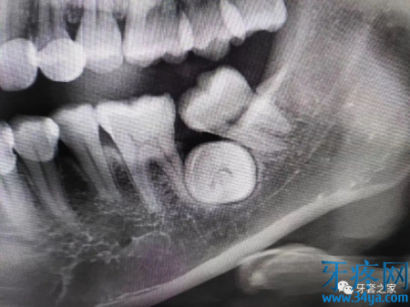 32岁骨性龅牙正畸