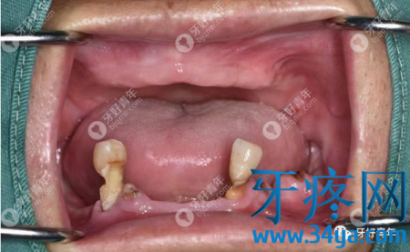 全口allon6种植牙真实案例,上下颌各种6颗植体