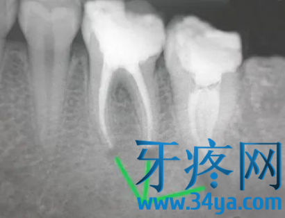 牙疼如何区分牙髓炎和根尖炎？
