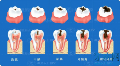 只是牙痛，怎么就需要根管治疗了！？