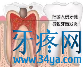 不同类型牙痛的用药技巧