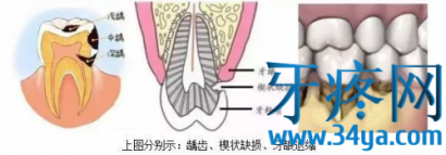 急性牙疼怎么办？