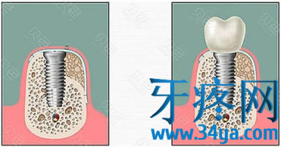 种植牙牙槽骨分类:一类骨、二类骨、三类骨、四类骨的区别