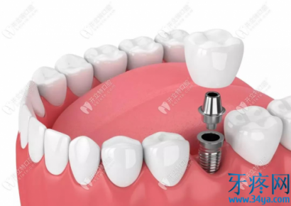 为什么牙槽骨萎缩会影响种牙？