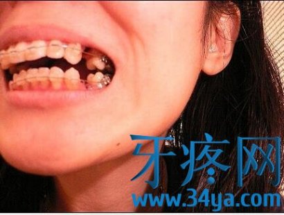 牙齿矫正到底要不要拔牙，拔牙到底有不有什么影响？