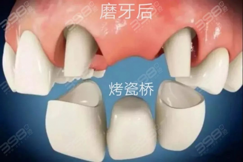 三颗牙连着缺失种植几颗牙好？