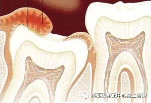 牙疼的种类:冠周炎、阻生智齿、牙髓炎...