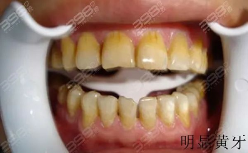 牙齿太黄了怎么变白？牙齿美白哪种方法好？