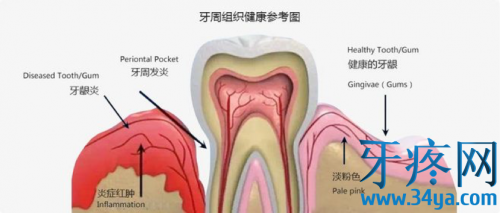口腔中最容易被忽视的口腔疾病牙周炎