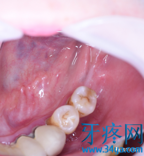 种植牙术后左下牙槽神经损伤即刻处理