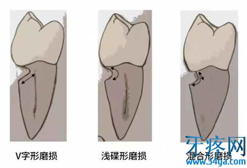 牙齿酸痛常见原因——楔状缺损