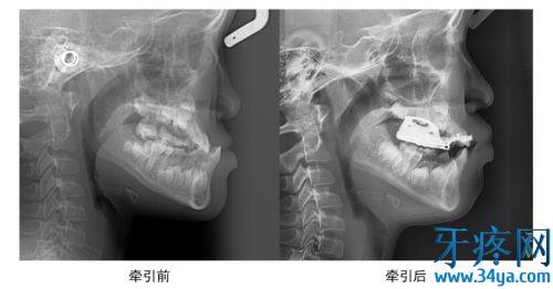 牙齿矫正最佳时间是什么时候?