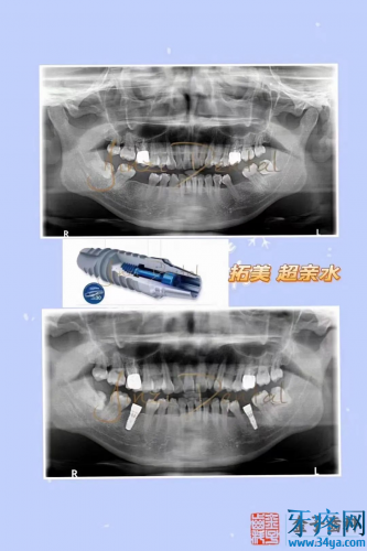 种植牙到底选什么？