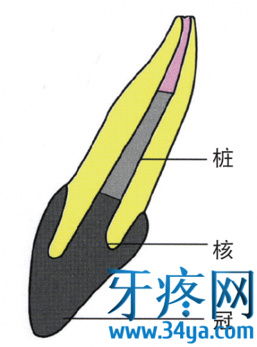 桩核冠是什么?如何选择桩核冠？