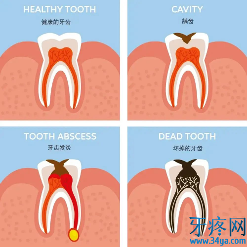 牙疼是上火?可能是牙髓炎