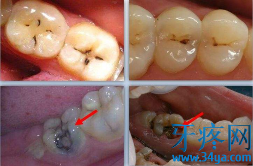 龋齿和蛀牙哪个更为严重？